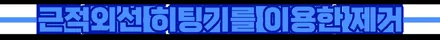더운날에 더 좋은 부천루프스킨 제거