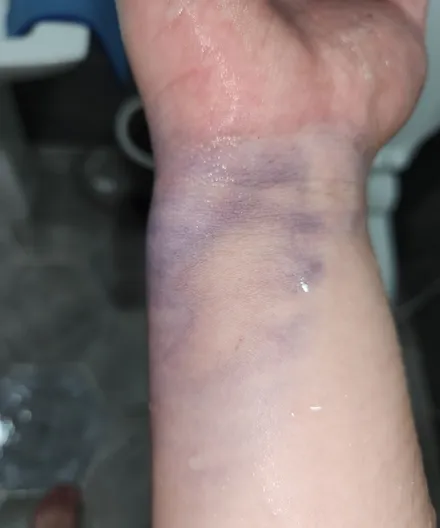 대구 메딕 카 케어 일요일 주말 루프스킨 제거함 / 대구 동구